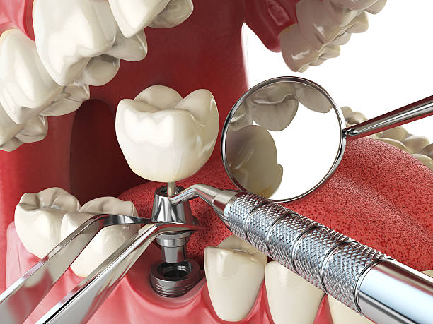 Best Emergency Wisdom Teeth Removal in Fort Branch, IN